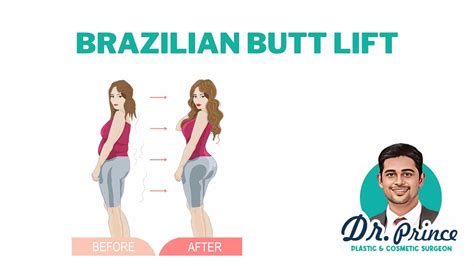 butt lift san antonio|Brazilian Butt Lift In San Antonio, TX